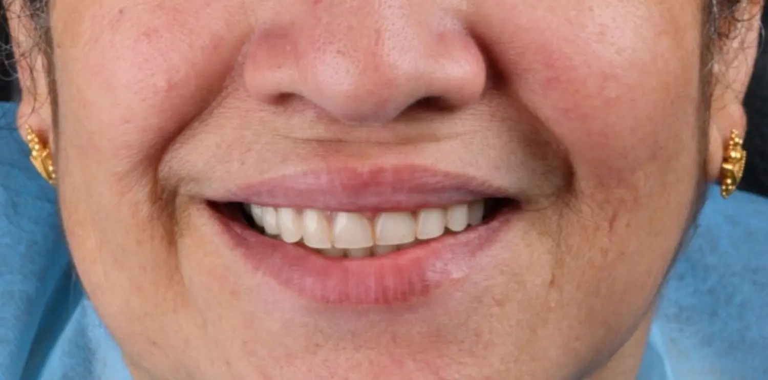 Dental Implant Results